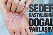 Sedef Hastalığına Doğal Yaklaşım